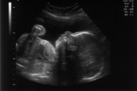 Pregnant Scan 60